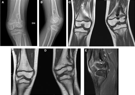 X-ray (A,B) and MRI (C–E) highlighted the results of the recent... | Download Scientific Diagram