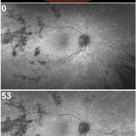 Fundus appearance of the right eye. Color fundus photo (top panel)... | Download Scientific Diagram