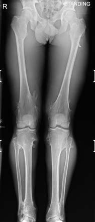 Hereditary multiple exostoses (HME) | Radiology Case | Radiopaedia.org