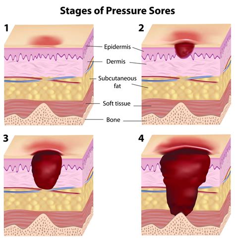 Bed Sores - Pressure Sores - Decubitus Ulcers Archives - Counselor Offices