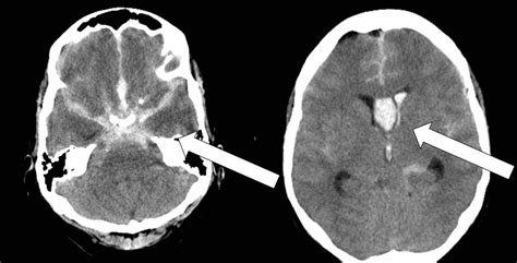 Cureus | Management of Poor-Grade Aneurysmal Subarachnoid Hemorrhage ...