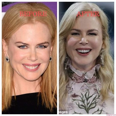 Nicole Kidman Plastic Surgery Photos [Before & After] ⋆ Surgery4