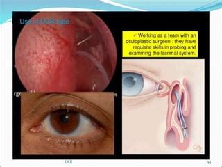 DACRYOCYSTORHINOSTOMY (DCR) - Powerpoint | PPT