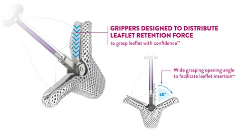 MitraClip Transcatheter Mitral Valve Repair (TMVr) | Abbott