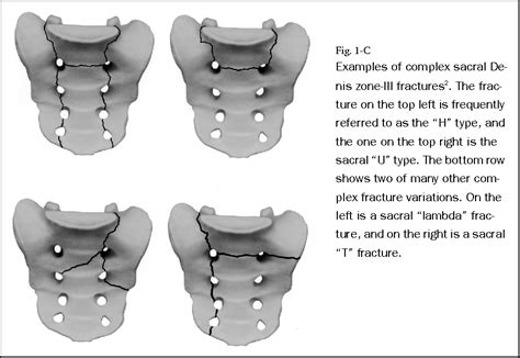 Figure 1 from Diagnosis and management of sacral spine fractures. | Semantic Scholar