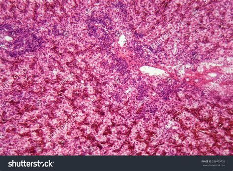 Human Liver Cells Cancer Under Microscope Stock Photo 536479735 | Shutterstock