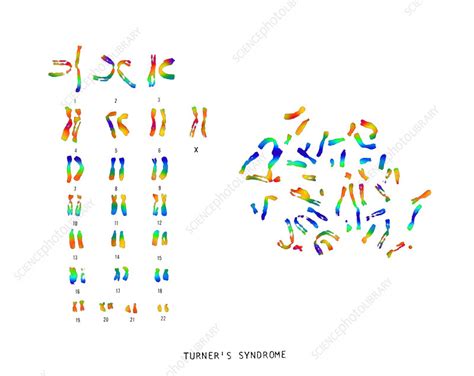 Turner's Syndrome Karyotype - Stock Image - C022/0559 - Science Photo Library