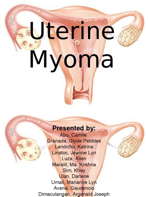 this is it- myoma case presentation | Uterus | Ovarian Cancer