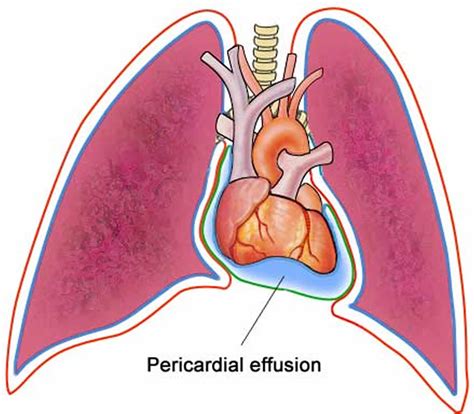 Pericardial Effusion - Causes, Symptoms, Diagnosis, Prognosis, Treatment