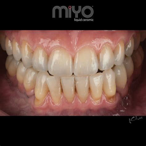 20 Reasons To Love MiYO Liquid Ceramic - Jensen Dental