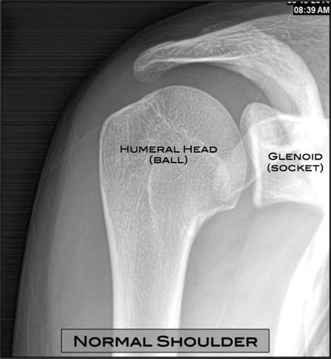 Shoulder Arthritis Austin, TX | Shoulder Surgery Austin, TX ...