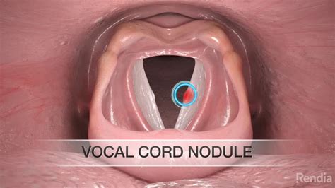 Infos Kesehatan: Acid Reflux And Throat Nodules