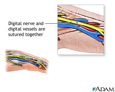 Replantation of digits - series—Procedure, part 2: MedlinePlus Medical Encyclopedia