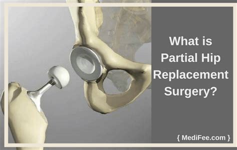 Which Method Of Hip Replacement Is The Best - designtapeter