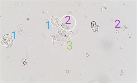 Urine Sediment Of The Month: Flavors Of Nucleated Cells, 57% OFF