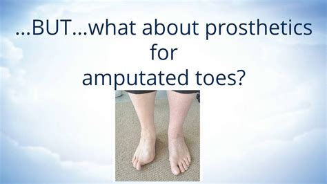 Toe Amputation Icd 10 - Asking List