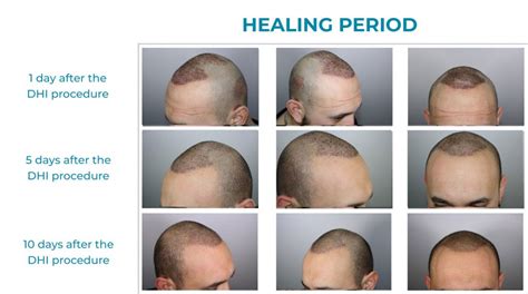 Hair Transplant Step by Step | Direct Hair Implant | DHI Panamá