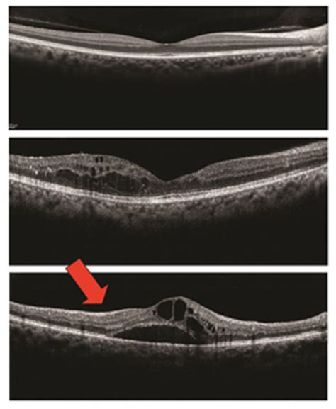 Macular Edema - Patients - The American Society of Retina Specialists