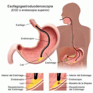 Esofagogastroduodenoscopia « Unidad de Endoscopía Dr. Jesús Fragoso Bernal