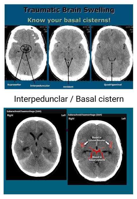 Interpedunclar / Basal cistern | Radiology imaging, Biology facts ...