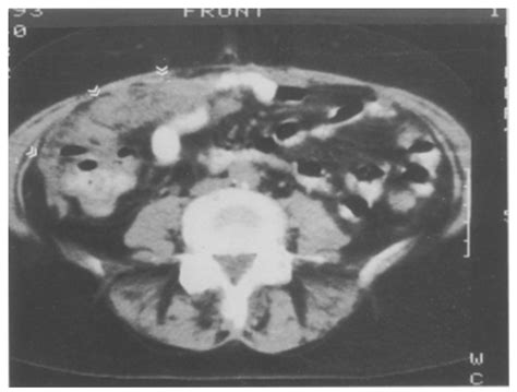 CT scan of same patient as Fig. 4 at the level of the aortic... | Download Scientific Diagram