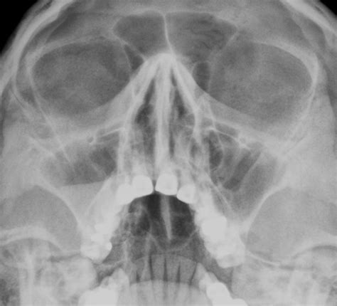 ACUTE MAXILLARY SINUSITIS | Buyxraysonline