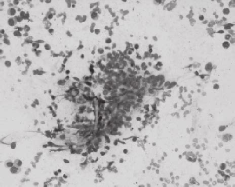 Peripheral smear showing pancytopenia (400 x Wright’s stain). | Download Scientific Diagram