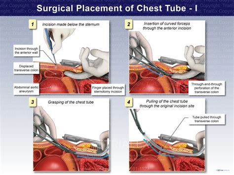 Surgical Placement of Chest Tube - I - TrialQuest Inc.