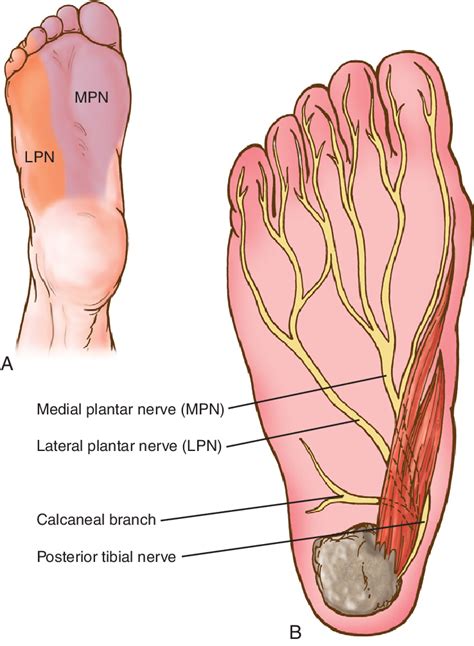 Tarsal tunnel. Compression of either the posterior tibial nerve at the... | Download Scientific ...