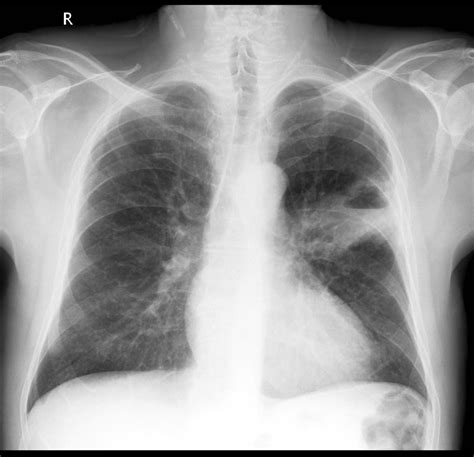 Squamous cell carcinoma of the lung chest x ray - wikidoc