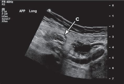 Appendicitis: a pictorial essay - Seow - 2011 - Australasian Journal of Ultrasound in Medicine ...