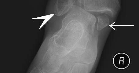 Bimalleolar Fracture Treatment | Symptoms | Healing