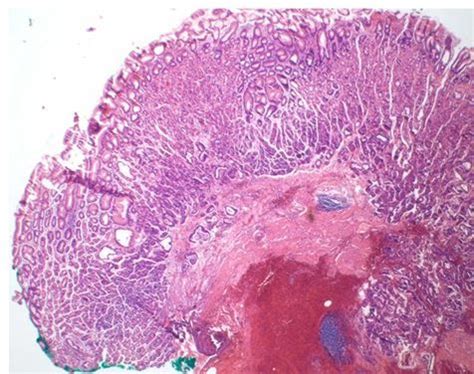 Giant Fundic Gland Polyp