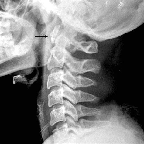 Lateral Cervical X Ray