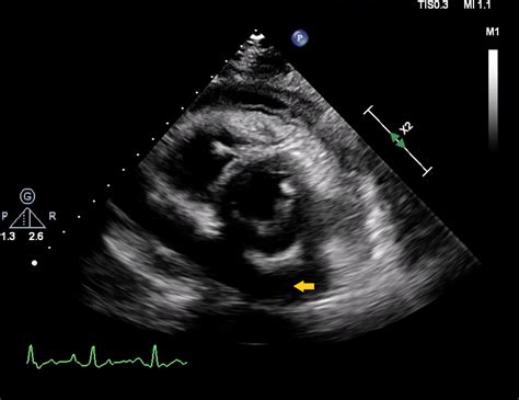 Cureus | Pericardial Effusion: Rare Adverse Effect of Clozapine