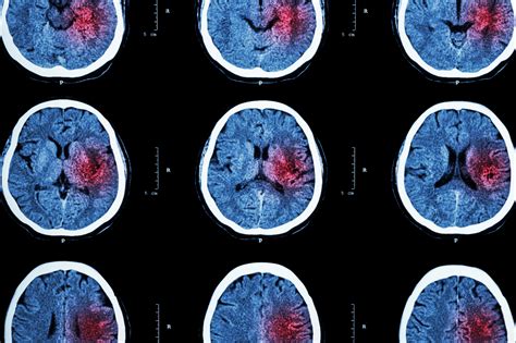 Ischemic Stroke: MedlinePlus