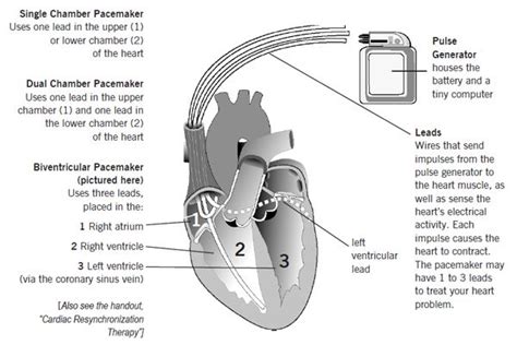 Cleveland Clinic - Pacemaker Implant | Cardiac nursing, Nurse skills ...