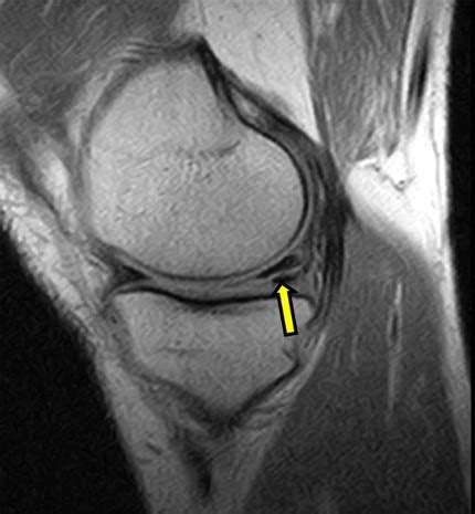 RMN de la rodilla