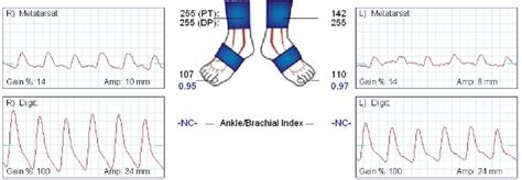 Toe Brachial Index