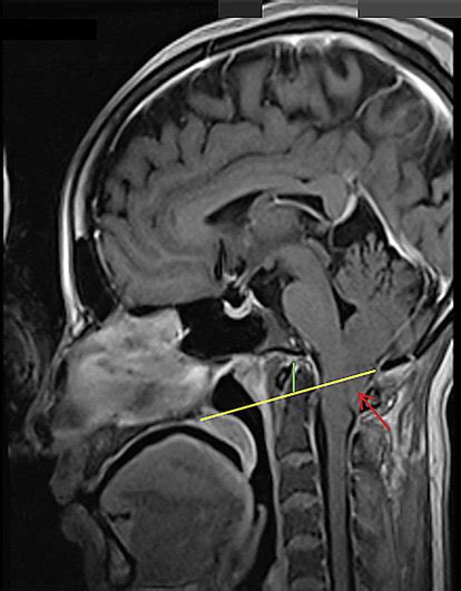 MRI of brain report: Peg-like cerebellar tonsillar herniation 2 cm... | Download Scientific Diagram