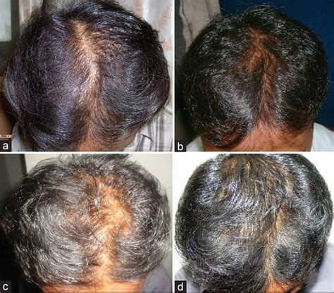 Minoxidil Combined With Finasteride: An Expert Review - Wimpole Clinic