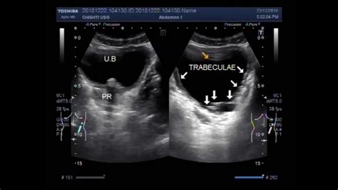 Urinary Bladder Ultrasound