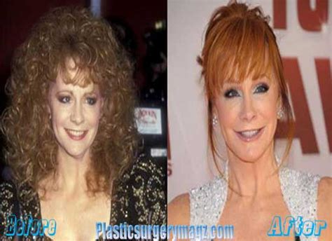 Reba Mcentire Plastic Surgery Before and After | Plastic Surgery Magazine