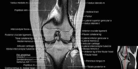 MRI Knee Anatomy | Mri, Knee mri, Meniscus tear