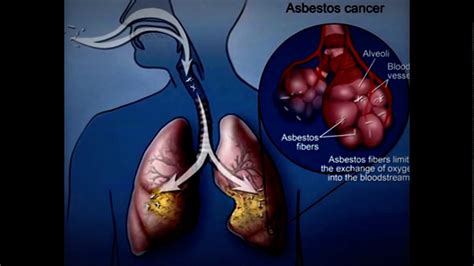 Lung Cancer as related to Asbestos - Pictures