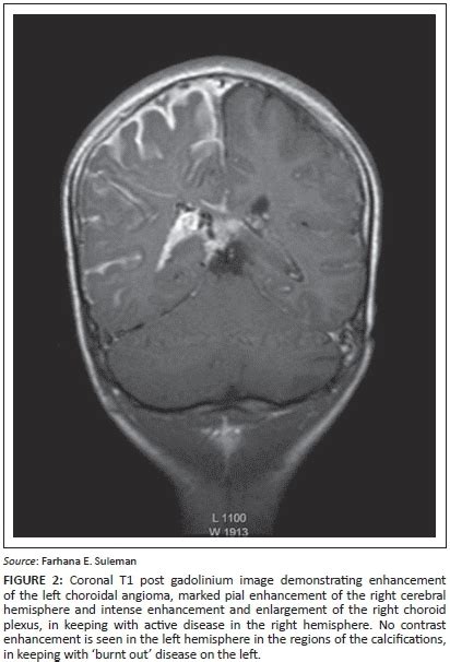 Sturge Weber Mri