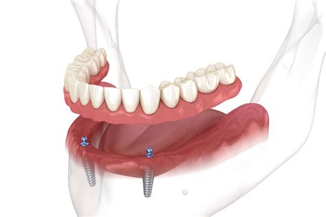 Implant Overdenture Steps and Clinical Protocol | Dandy