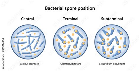 The position of bacillus spores: central, terminal, subterminal. The figure shows three ...