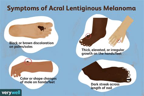 Acral Lentiginous Melanoma Metastatic Melanoma