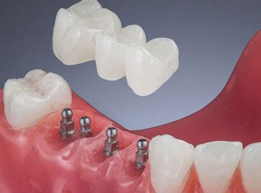 Mini Dental Implants Delhi India Mini Teeth Implants Cost Delhi India